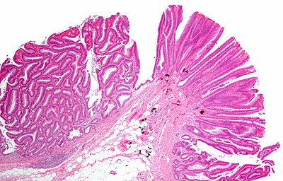 Tubulovillous adenoma.jpg