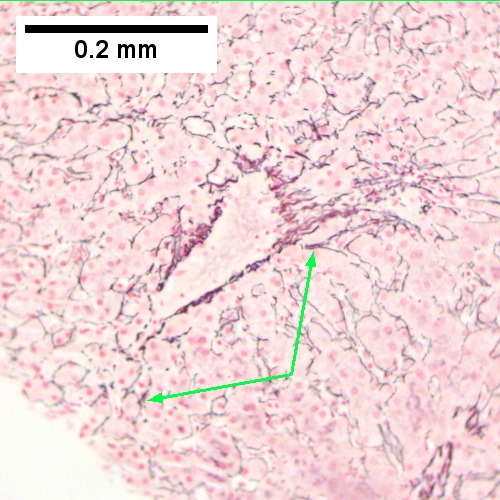 Hepatitis C virus. Metavir Activity Index 1 (PMN 0 LN 1).