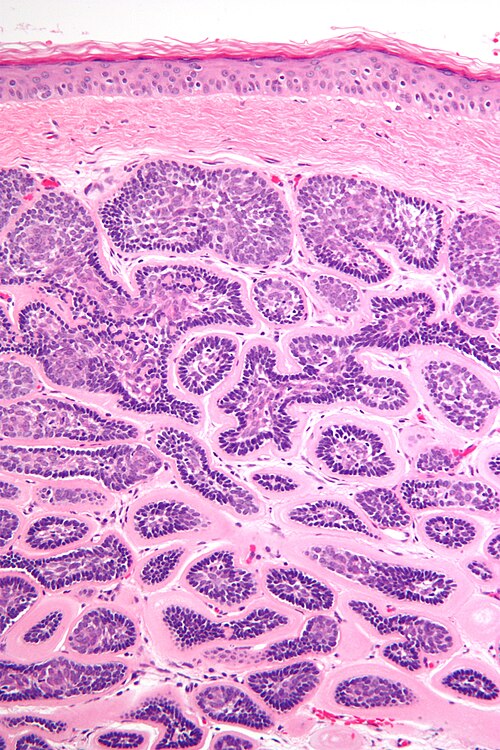 Dermal cylindroma intermed mag deep.jpg