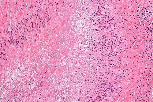 Rheumatoid nodule - high mag.jpg