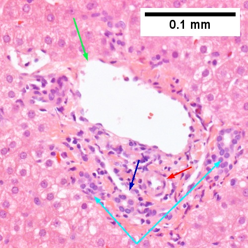 Steatohepatitis. Brunt necroinflammatory grade 1. Brunt fibrosis stage 1.