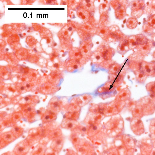 Steatohepatitis. Brunt necroinflammatory grade 1. Brunt fibrosis stage 1.