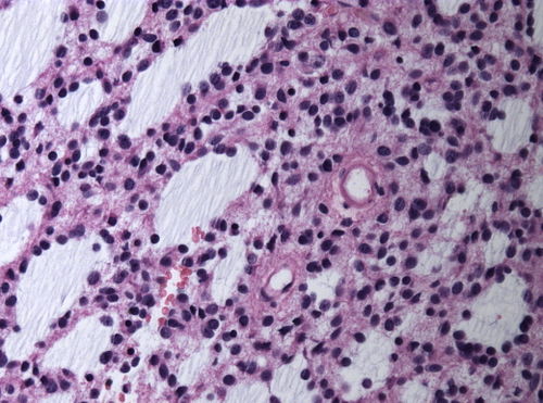 Neuropathology case II 03.jpg