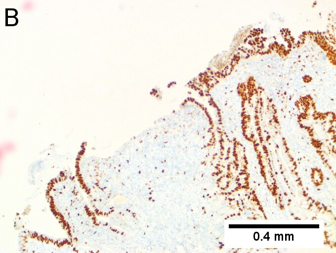 Invasive carcinoma of duodenal ampulla.