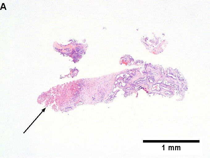 Metastatic thyroid carcinoma to liver