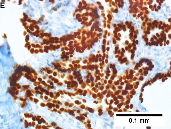 Metastatic thyroid carcinoma to liver