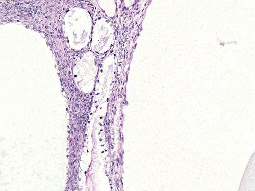 High magnification of tubulocystic clear cell carcinoma of the ovary.jpg