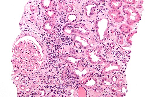 Membranous nephropathy - he - high mag.jpg