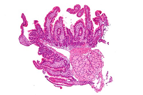 Whipple disease - low mag.jpg