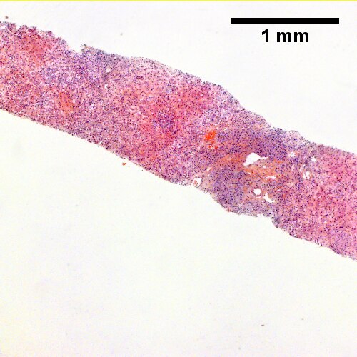 Acini & lobules distorted by inflammation