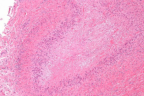 Rheumatoid nodule - intermed mag 2.jpg