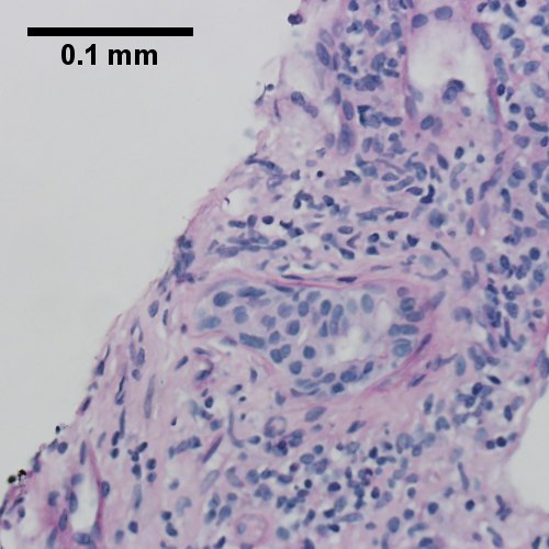 Damaged bile duct, PAS with diastase