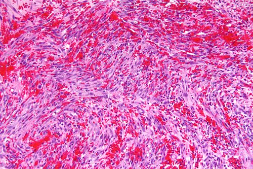 Kaposi sarcoma low intermed mag.jpg