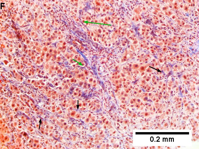 Drug induced liver injury in a young adult man