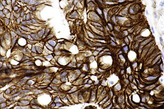 beta-catenin IHC