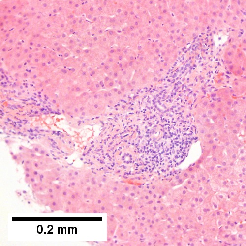 Hepatitis C virus. Metavir Activity Index 1 (PMN 0 LN 1).