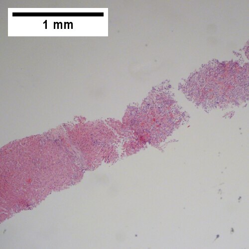 Metastatic poorly differentiated neuroendocrine carcinoma of pulmonary origin.