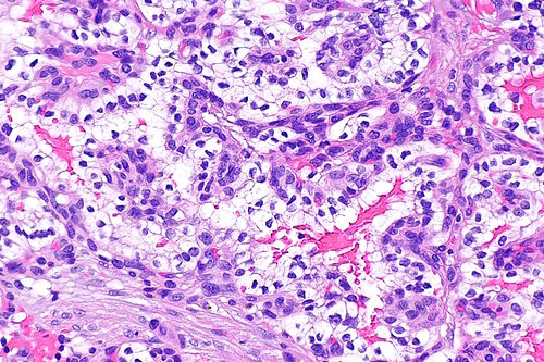 Papillary cystadenoma of epididymis -- high mag.jpg