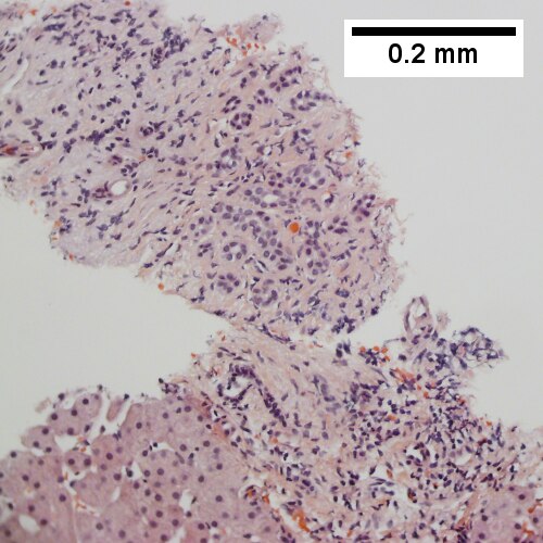 Tortuous bile ducts, not to be considered generalized in presence of mass (200X).