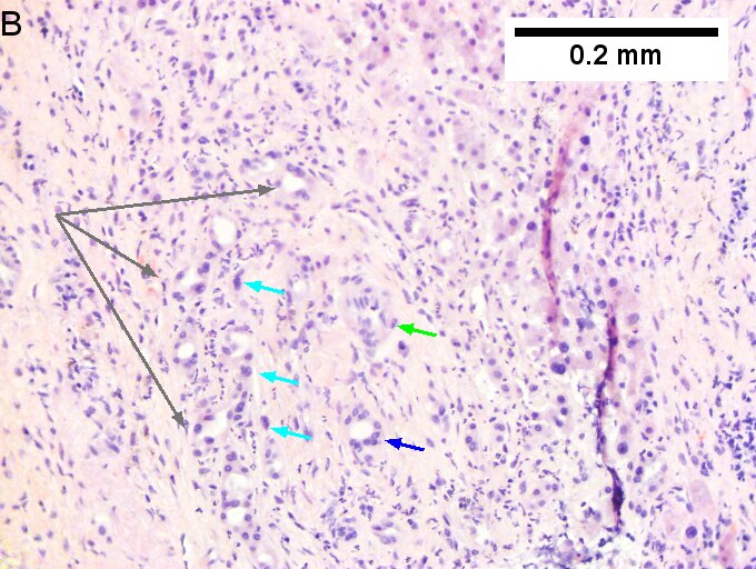 Cholangiocarcinoma with associated abscess