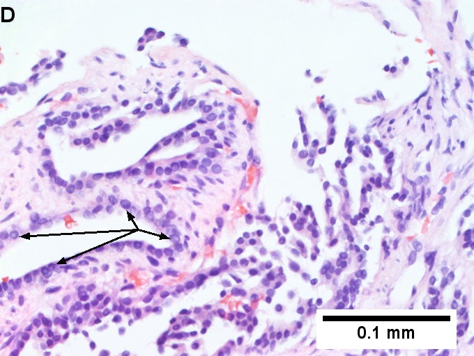 Metastatic thyroid carcinoma to liver