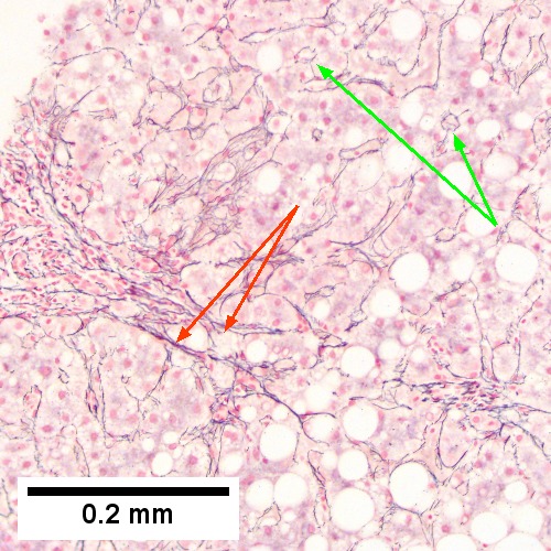 Hepatitis C. Metavir Activity Index 2 (PMN2, LN1), Metavir fibrosis stage 3