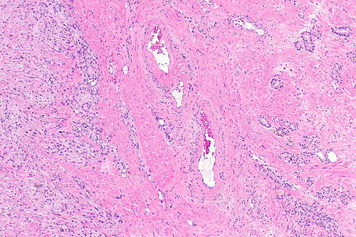 Sarcomatoid prostate carcinoma -- low mag.jpg