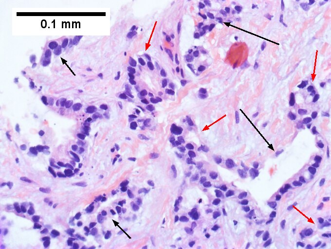 Cholangiocarcinoma, intrahepatic, small duct type.