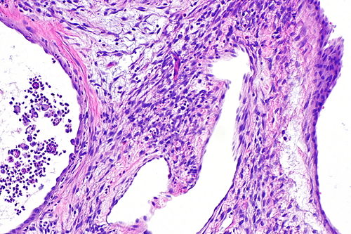 Cystic nephroma -- intermed mag.jpg