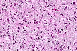 Anaplastic astrocytoma - very high mag.jpg