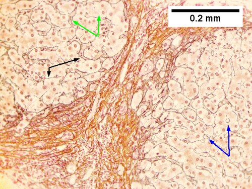 Hepatitis C virus. Metavir activity index 3 (PMN 2, LN 2). Metavir stage 4 (cirrhosis, definite by old criteria).