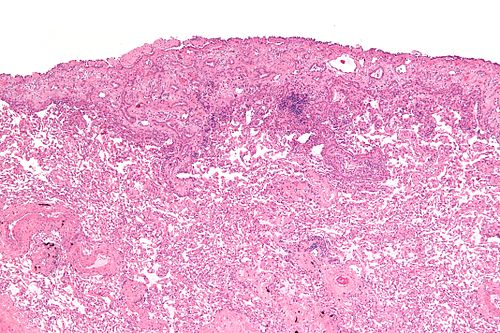 Malignant epithelioid mesothelioma - low mag.jpg