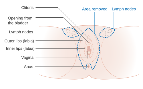 Schematic showing what is removed in a vulvectomy.