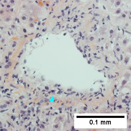 Central vein is inflamed with a rare plasma cell (cyan arrowhead) (400X).