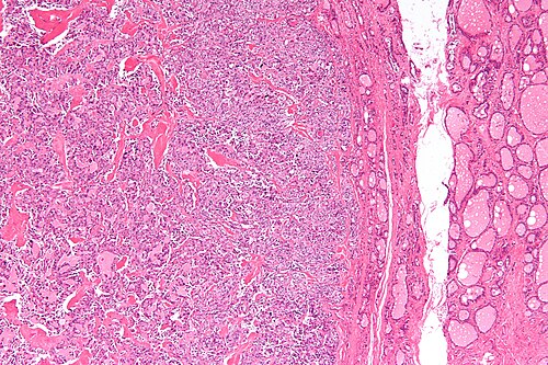 Medullary thyroid carcinoma - low mag.jpg