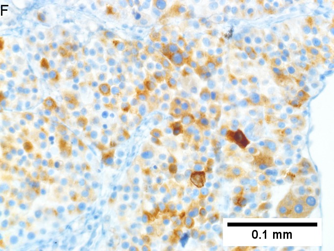 Melanoma metastatic to liver.