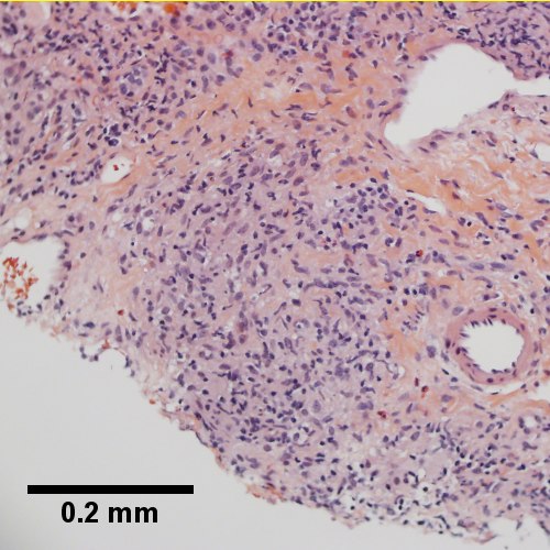 Loose granuloma in triad without duct