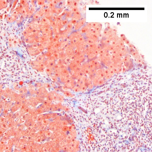 HCR. Metavir Activity Index 2 (PMN 1 LN 2) Metavir fibrosis stage 3.