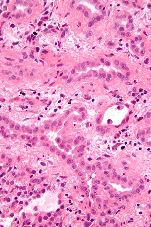 Malignant epithelioid mesothelioma - very high mag.jpg