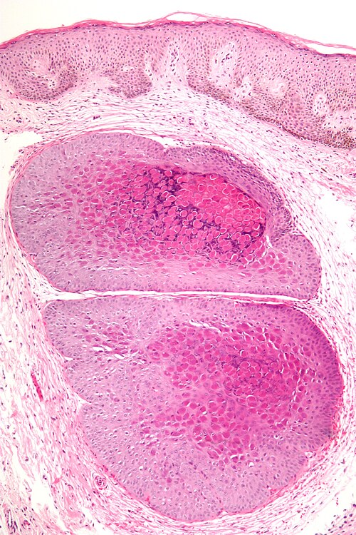 Molluscum contagiosum low mag.jpg