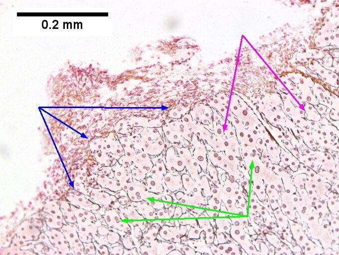 Hepatitis B virus. Metavir activity index 3 {PMN 2 LN 2]. Metavir fibrosis stage 4 (advanced fibrosis/cirrhosis).