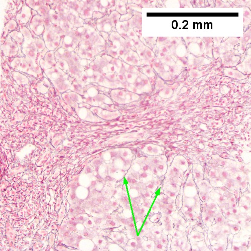 Hepatitis C. Metavir Activity Index 2 (PMN2, LN1), Metavir fibrosis stage 3