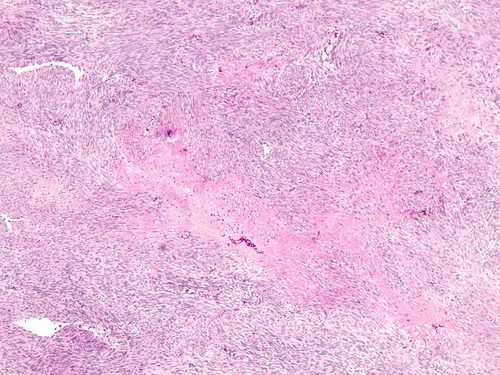 Leiomyoma with changes secondary to tranexamic acid treatment low magnification.jpg