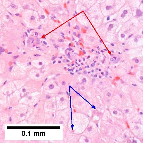 Alcoholic hepatitis with Metavir stage IV fibrosis (advanced fibrosis/cirrhosis).