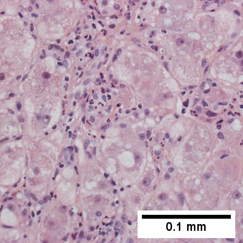 Enlarged hepatocytes, some with feathery degeneration, others with steatosis. Nuclei show nucleoli (400X).