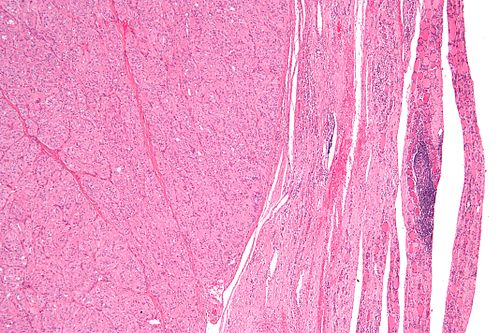 Hyalinized trabecular tumour - low mag.jpg