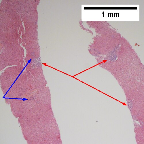 Hepatitis C virus. Metavir Activity Index 1 (PMN 0 LN 1).