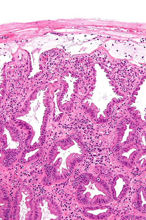 Ischemic colitis - high mag.jpg