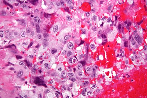 Choriocarcinoma - very high mag.jpg