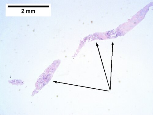 Cholangiocarcinoma, intrahepatic, small duct type.
